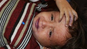 تقرير أممي: وفاة 15 طفلا بالحصبة وإصابة 1400 آخرين في اليمن خلال 7 أشهر