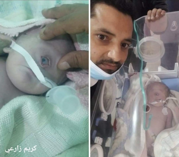 ولادة طفل بعين واحدة بحالة نادرة عالميا في محافظة البيضاء