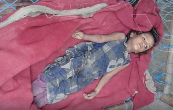 مأساة الطفلة أشواق.. الموت جوعًا في أحد مخيمات حجة (تقرير)