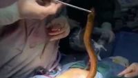 استخراج ثعبان من جسم مريض في الصين (فيديو)